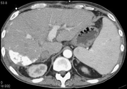 Prior Hepatic Infarct in Transplanted Liver - CTisus CT Scan