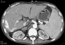 Prior Hepatic Infarction - CTisus CT Scan