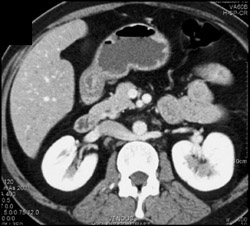 Candidiasis in Liver - CTisus CT Scan