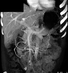 Normal Venous Anatomy - CTisus CT Scan