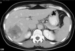 Hemangioma - CTisus CT Scan