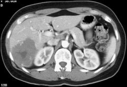 Hemangioma - CTisus CT Scan