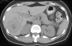 Hemangioma - CTisus CT Scan