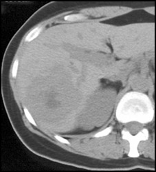 Hemangioma - CTisus CT Scan