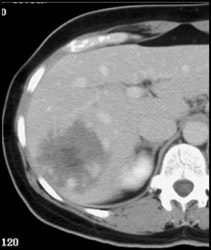 Hemangioma - CTisus CT Scan