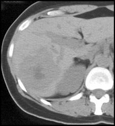 Hemangioma - CTisus CT Scan