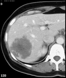 Hemangioma - CTisus CT Scan