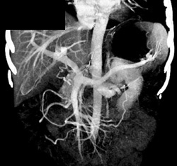 MIP of Hepatic Venous System - CTisus CT Scan