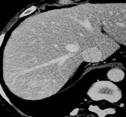 Focal Nodular Hyperplasia (FNH) - CTisus CT Scan