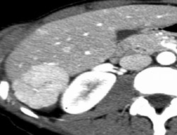 Focal Nodular Hyperplasia (FNH) - CTisus CT Scan