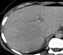 Focal Nodular Hyperplasia (FNH) - CTisus CT Scan