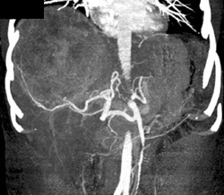 Hepatoma - CTisus CT Scan