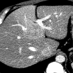 Focal Nodular Hyperplasia (FNH) - CTisus CT Scan