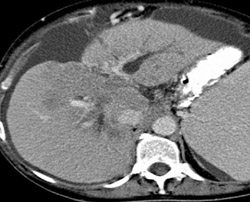 Cholangiocarcinoma - CTisus CT Scan