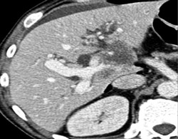 Cholangiocarcinoma - CTisus CT Scan