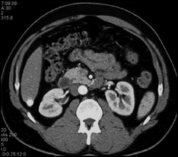 Hepatoma - CTisus CT Scan