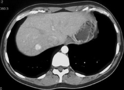 Focal Nodular Hyperplasia (FNH) - CTisus CT Scan