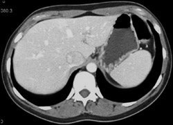 Focal Nodular Hyperplasia (FNH) (washout) - CTisus CT Scan