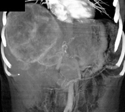 Hepatoma - CTisus CT Scan