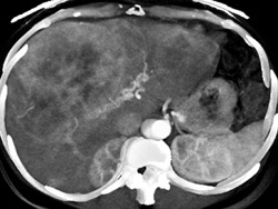 Hepatoma - CTisus CT Scan