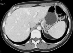 Focal Nodular Hyperplasia (FNH) - CTisus CT Scan