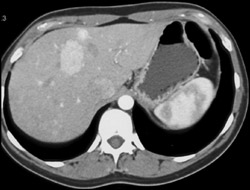 Focal Nodular Hyperplasia (FNH) - CTisus CT Scan