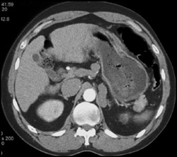 Varix Simulates Left Adrenal Lesion - CTisus CT Scan