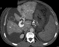 Portal Vein Thrombosis (PVT) Due to Hepatoma - CTisus CT Scan