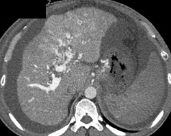 Clot in Portal Vein With Cavernous Transformation of the Portal Vein - CTisus CT Scan