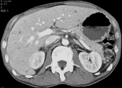 Liver Abscesses (candidiasis) - CTisus CT Scan