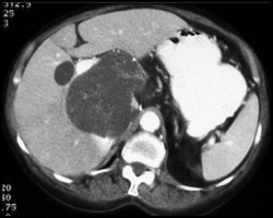 2 Examples of Biliary Cystadenoma - CTisus CT Scan