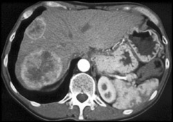 Metastatic Carcinoid Tumor - CTisus CT Scan