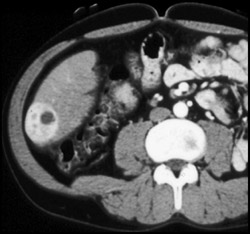 Hepatoma - CTisus CT Scan