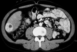 Hepatoma - CTisus CT Scan