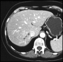 Angiomyolipoma - CTisus CT Scan