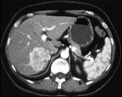 Hepatic Angiomyolipoma - CTisus CT Scan