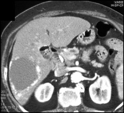 Hemangioma - CTisus CT Scan