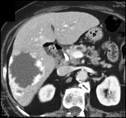 Hemangioma - CTisus CT Scan