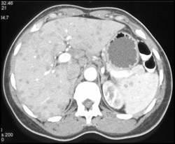 Peliosis Hepatitis - CTisus CT Scan