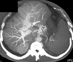 Cirrhosis With Portal Vein Thrombus - CTisus CT Scan