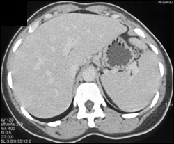 On Delayed Phase Peliosis Hepatitis Became Isodense - CTisus CT Scan