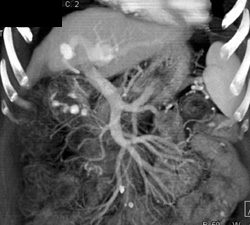 Dilated Portal Vein - CTisus CT Scan