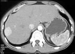 Hepatoma - CTisus CT Scan