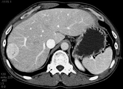 Hepatoma - CTisus CT Scan