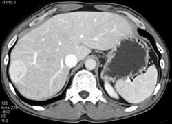 Hepatoma - CTisus CT Scan