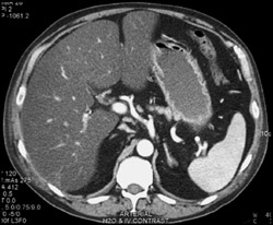 Fatty Liver - CTisus CT Scan