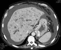 Dilated Ducts in Cirrhotic Liver - CTisus CT Scan