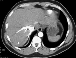 Reflux Into Inferior Vena Cava (IVC) - CTisus CT Scan