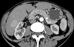 Focal Nodular Hyperplasia (FNH) - CTisus CT Scan