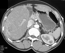 Multifocal Hepatoma - CTisus CT Scan